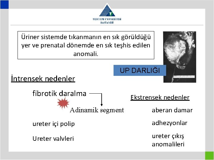 Üriner sistemde tıkanmanın en sık görüldüğü yer ve prenatal dönemde en sık teşhis edilen