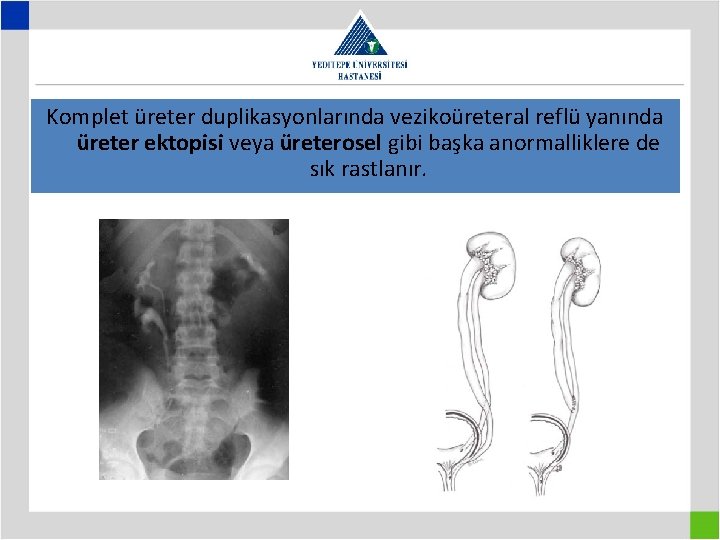 Komplet üreter duplikasyonlarında vezikoüreteral reflü yanında üreter ektopisi veya üreterosel gibi başka anormalliklere de