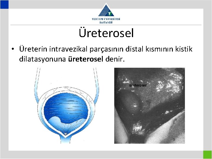 Üreterosel • Üreterin intravezikal parçasının distal kısmının kistik dilatasyonuna üreterosel denir. üreterosel 