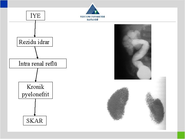 İYE Rezidu idrar İntra renal reflü Kronik pyelonefrit SKAR 