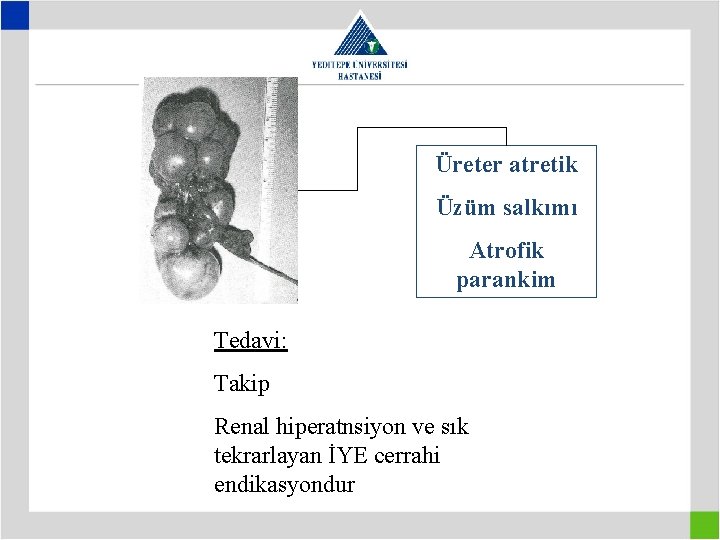 Üreter atretik Üzüm salkımı Atrofik parankim Tedavi: Takip Renal hiperatnsiyon ve sık tekrarlayan İYE