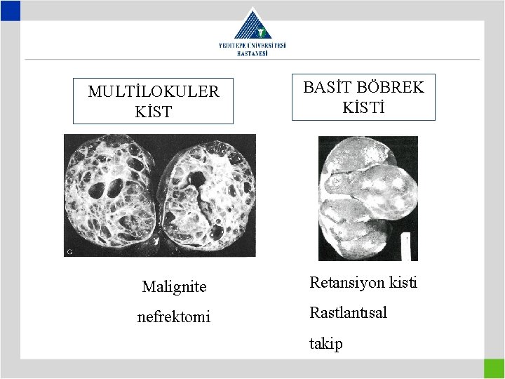 MULTİLOKULER KİST BASİT BÖBREK KİSTİ Malignite Retansiyon kisti nefrektomi Rastlantısal takip 