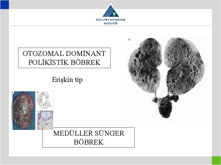 OTOZOMAL DOMİNANT POLİKİSTİK BÖBREK Erişkin tip MEDÜLLER SÜNGER BÖBREK 