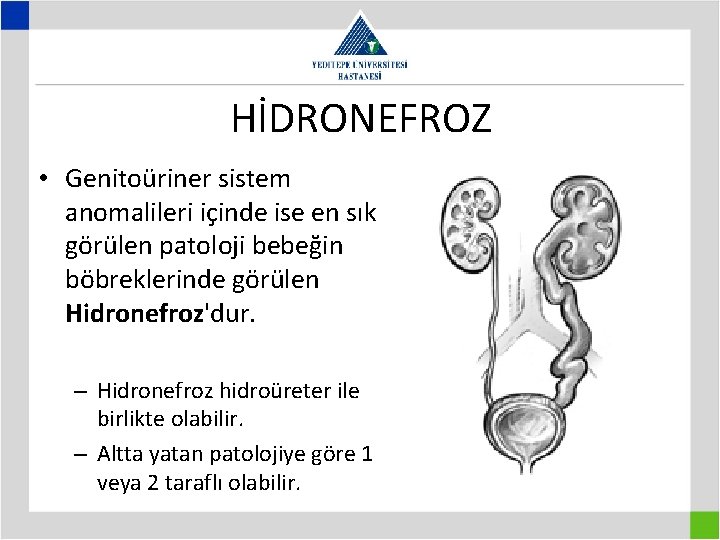 HİDRONEFROZ • Genitoüriner sistem anomalileri içinde ise en sık görülen patoloji bebeğin böbreklerinde görülen