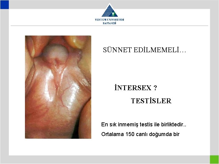 SÜNNET EDİLMEMELİ… İNTERSEX ? TESTİSLER En sık inmemiş testis ile birliktedir. . Ortalama 150