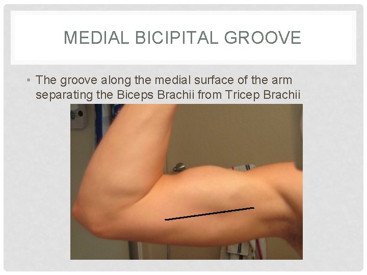 MEDIAL BICIPITAL GROOVE • The groove along the medial surface of the arm separating
