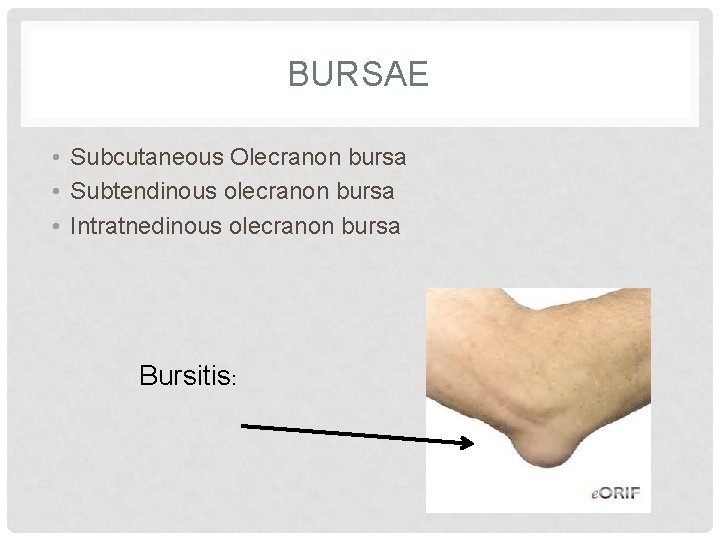 BURSAE • Subcutaneous Olecranon bursa • Subtendinous olecranon bursa • Intratnedinous olecranon bursa Bursitis: