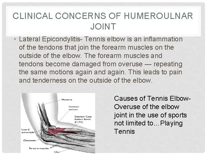 CLINICAL CONCERNS OF HUMEROULNAR JOINT • Lateral Epicondylitis- Tennis elbow is an inflammation of