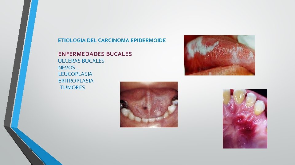 ETIOLOGIA DEL CARCINOMA EPIDERMOIDE ENFERMEDADES BUCALES ULCERAS BUCALES NEVOS. LEUCOPLASIA ERITROPLASIA TUMORES 