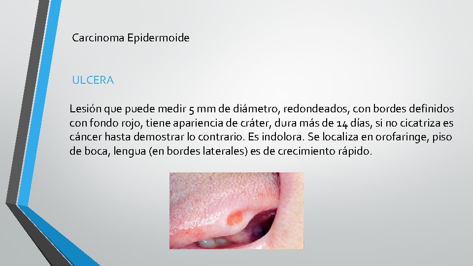 Carcinoma Epidermoide ULCERA Lesión que puede medir 5 mm de diámetro, redondeados, con bordes