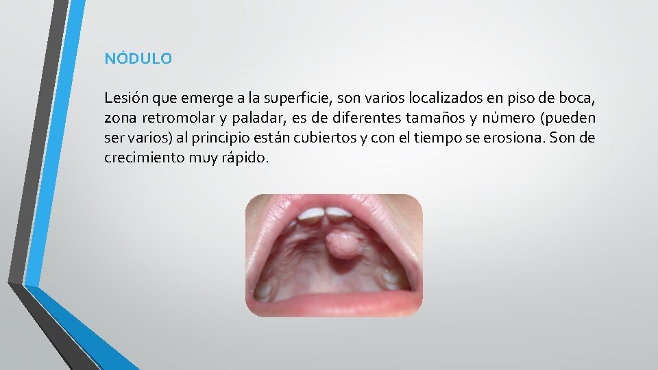 NÓDULO Lesión que emerge a la superficie, son varios localizados en piso de boca,