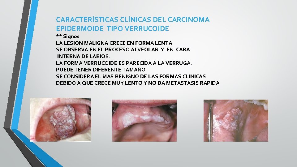 CARACTERÍSTICAS CLÍNICAS DEL CARCINOMA EPIDERMOIDE TIPO VERRUCOIDE ** Signos LA LESION MALIGNA CRECE EN