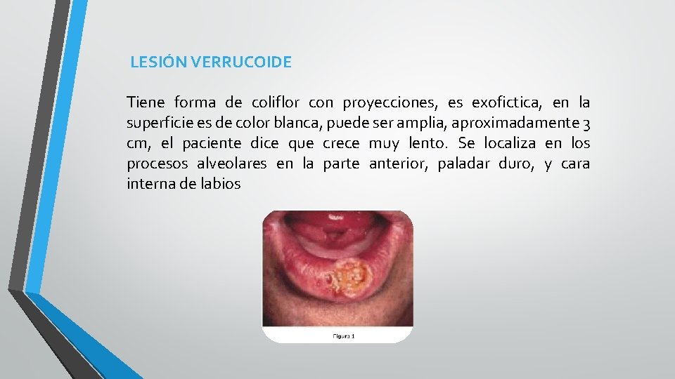 LESIÓN VERRUCOIDE Tiene forma de coliflor con proyecciones, es exofictica, en la superficie es