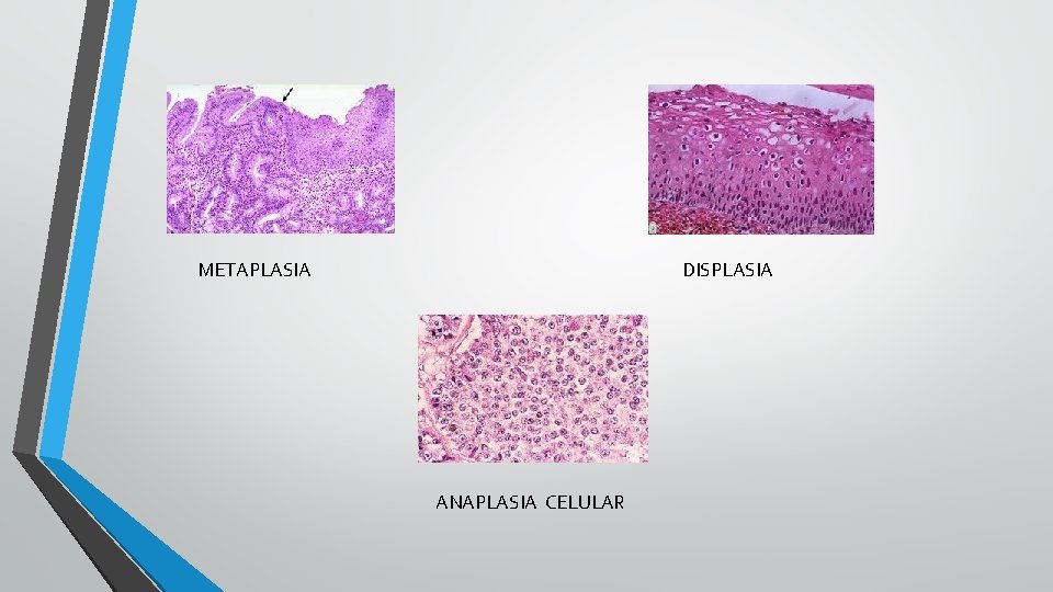 METAPLASIA DISPLASIA ANAPLASIA CELULAR 