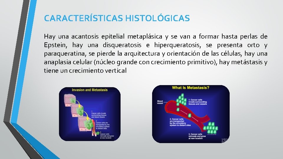 CARACTERÍSTICAS HISTOLÓGICAS Hay una acantosis epitelial metaplásica y se van a formar hasta perlas