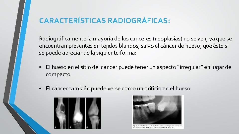 CARACTERÍSTICAS RADIOGRÁFICAS: Radiográficamente la mayoría de los canceres (neoplasias) no se ven, ya que