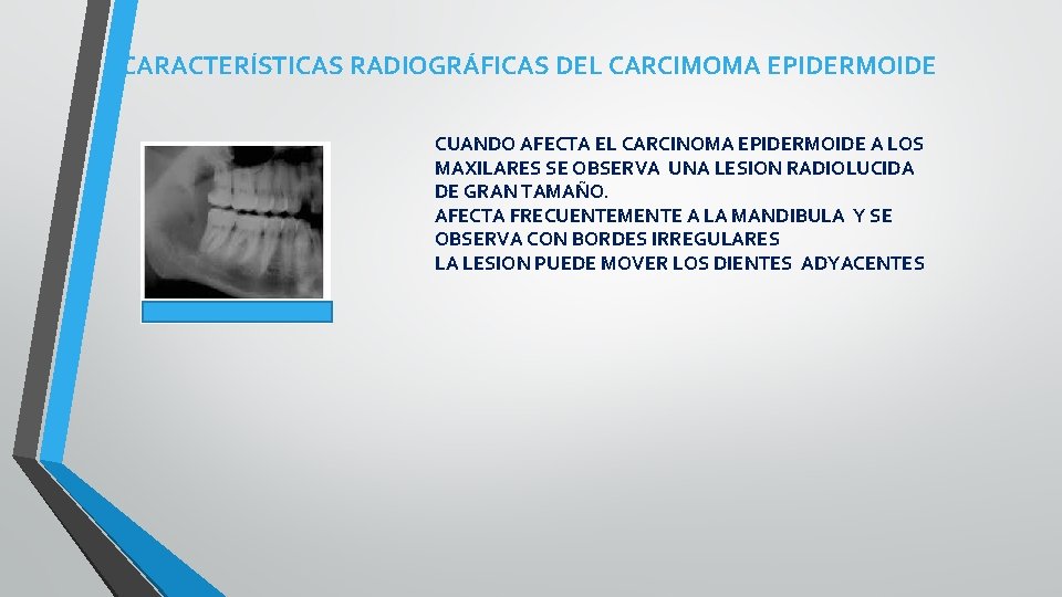 CARACTERÍSTICAS RADIOGRÁFICAS DEL CARCIMOMA EPIDERMOIDE CUANDO AFECTA EL CARCINOMA EPIDERMOIDE A LOS MAXILARES SE