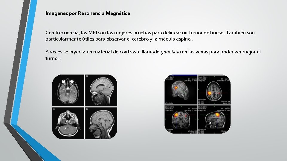Imágenes por Resonancia Magnética Con frecuencia, las MRI son las mejores pruebas para delinear