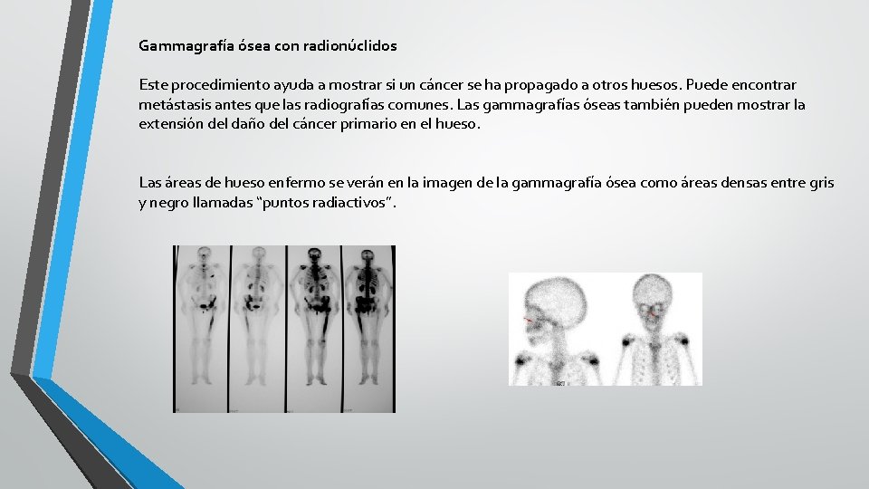 Gammagrafía ósea con radionúclidos Este procedimiento ayuda a mostrar si un cáncer se ha