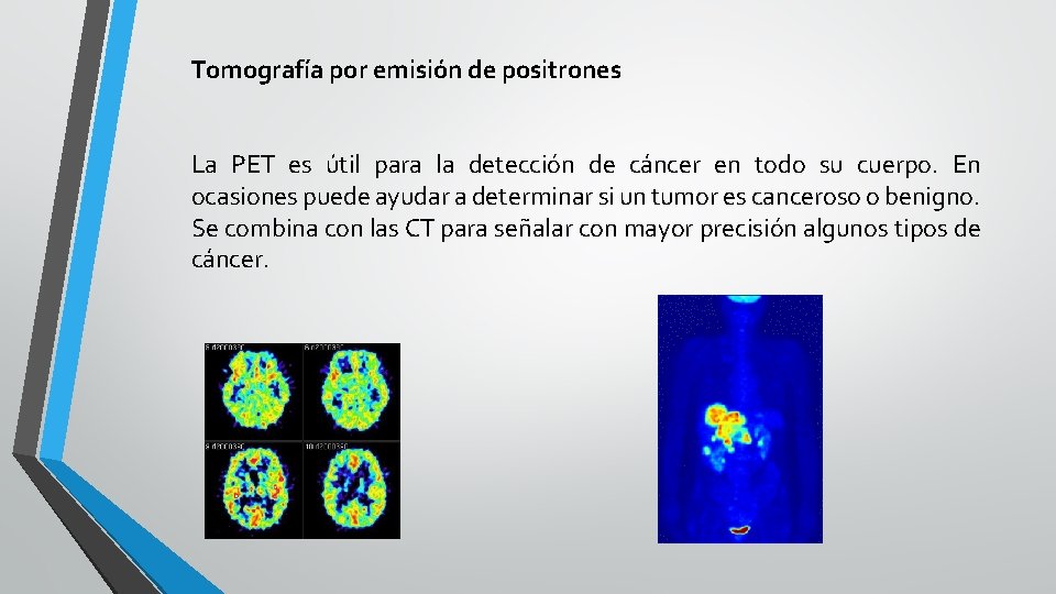 Tomografía por emisión de positrones La PET es útil para la detección de cáncer