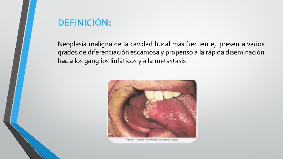 DEFINICIÓN: Neoplasia maligna de la cavidad bucal más frecuente, presenta varios grados de diferenciación