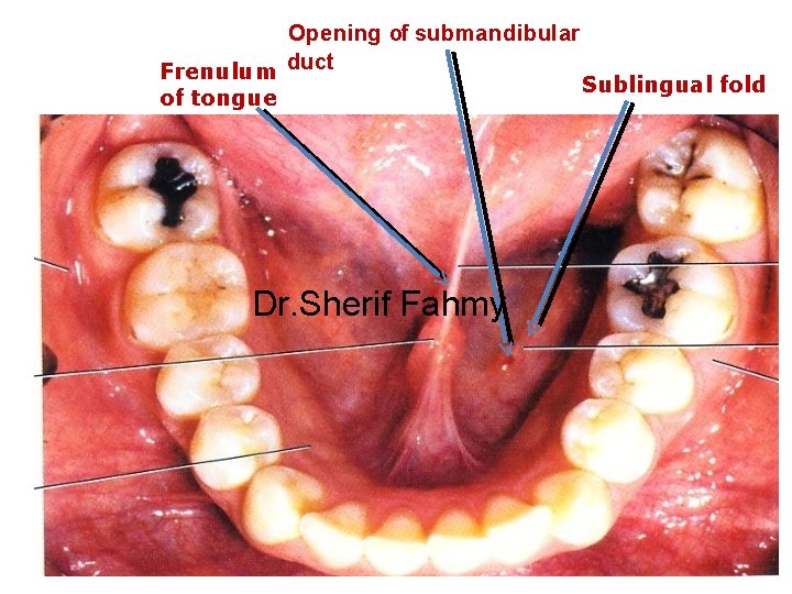 Opening of submandibular Frenulum duct Sublingual fold of tongue Dr. Sherif Fahmy 