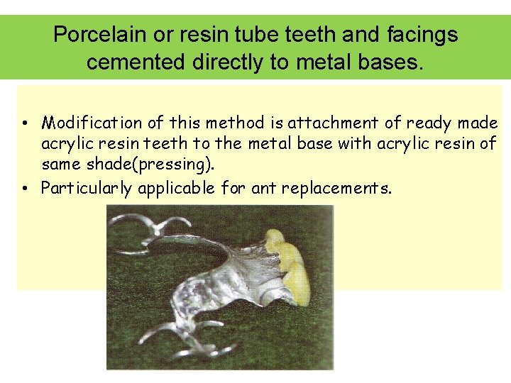 Porcelain or resin tube teeth and facings cemented directly to metal bases. • Modification