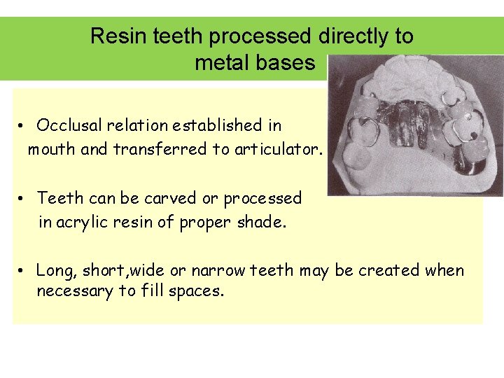 Resin teeth processed directly to metal bases • Occlusal relation established in mouth and