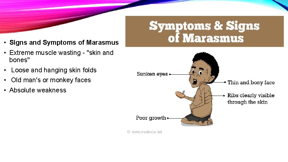  • Signs and Symptoms of Marasmus • Extreme muscle wasting - "skin and