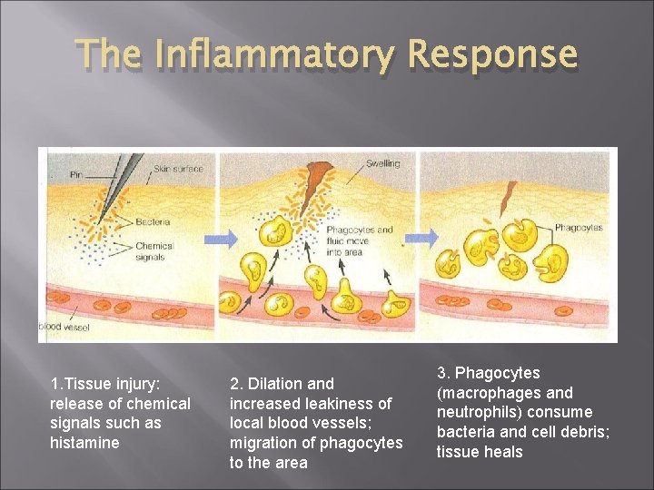 The Inflammatory Response 1. Tissue injury: release of chemical signals such as histamine 2.