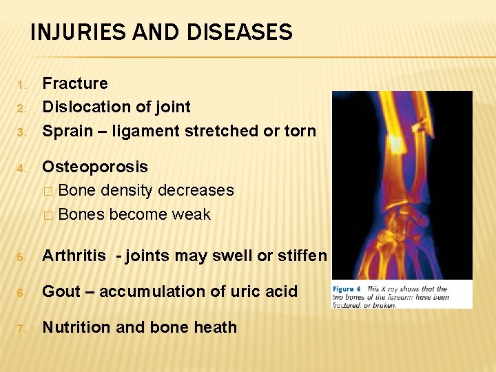 INJURIES AND DISEASES 1. 2. 3. Fracture Dislocation of joint Sprain – ligament stretched