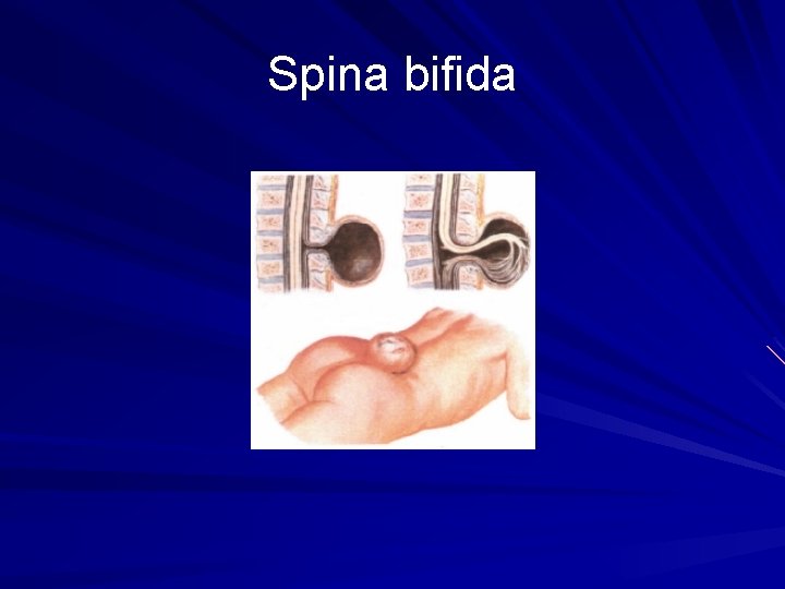 Spina bifida 