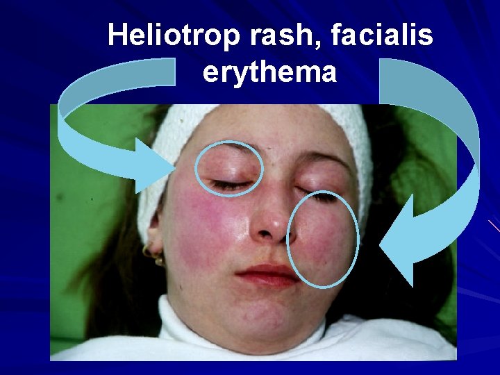 Heliotrop rash, facialis erythema 