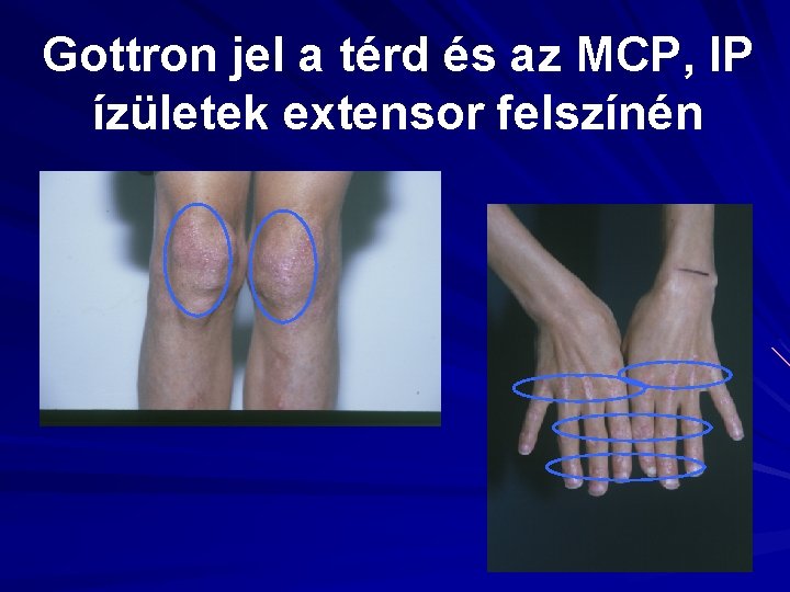 Gottron jel a térd és az MCP, IP ízületek extensor felszínén 