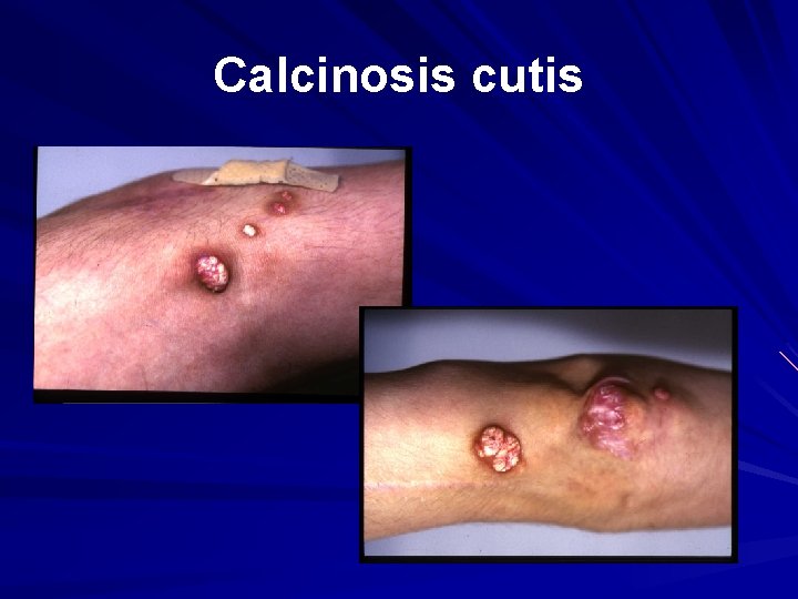 Calcinosis cutis 