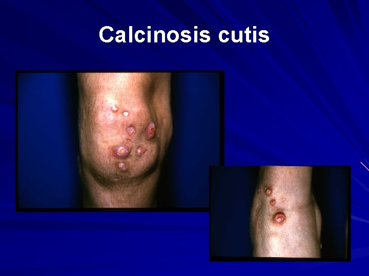 Calcinosis cutis 