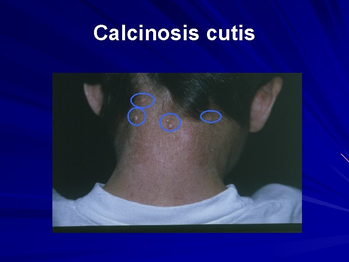 Calcinosis cutis 
