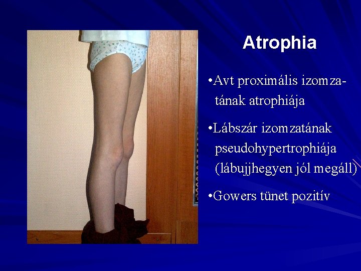 Atrophia • Avt proximális izomzatának atrophiája • Lábszár izomzatának pseudohypertrophiája (lábujjhegyen jól megáll) •