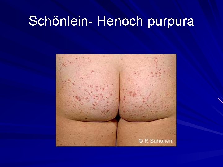 Schönlein- Henoch purpura 