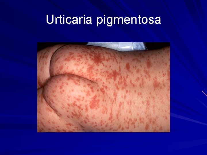 Urticaria pigmentosa 