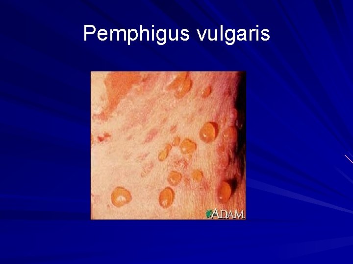 Pemphigus vulgaris 