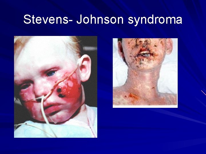 Stevens- Johnson syndroma 