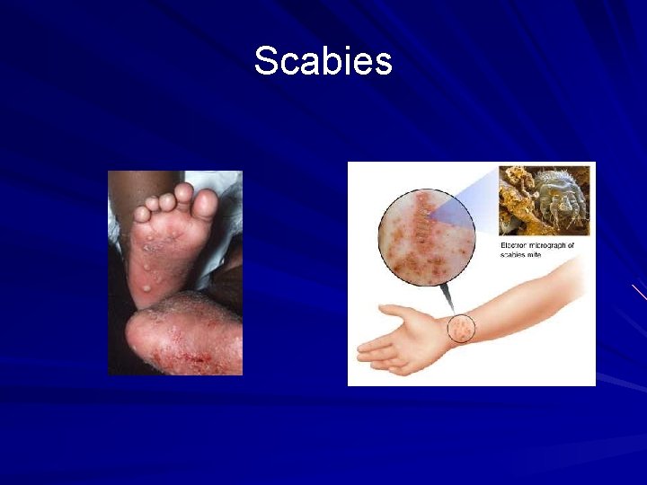 Scabies 