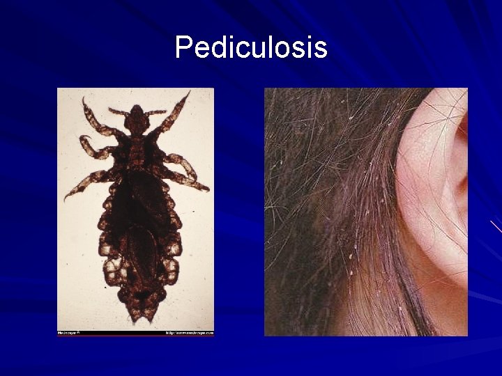 Pediculosis 