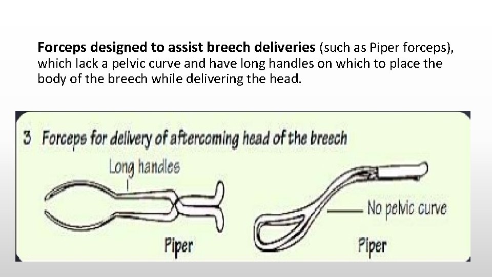 Forceps designed to assist breech deliveries (such as Piper forceps), which lack a pelvic