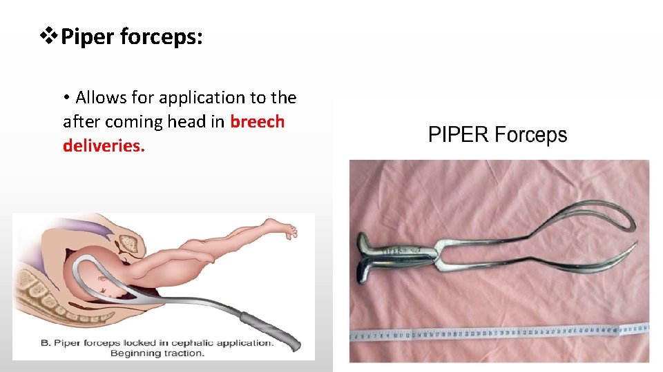  Piper forceps: • Allows for application to the after coming head in breech