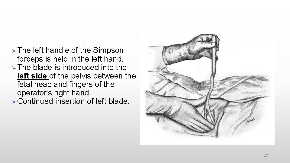  The left handle of the Simpson forceps is held in the left hand.