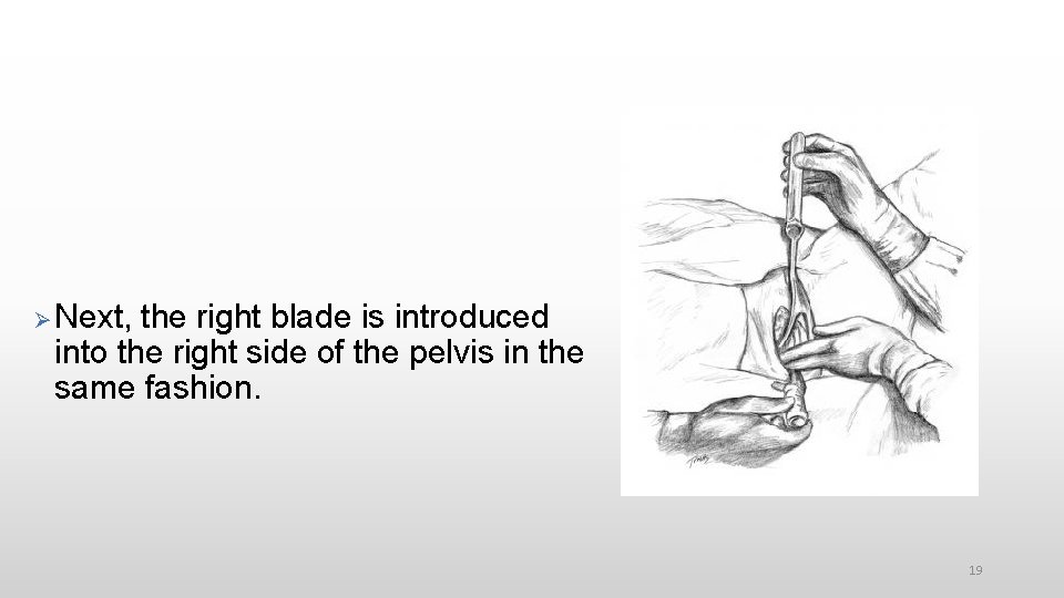  Next, the right blade is introduced into the right side of the pelvis