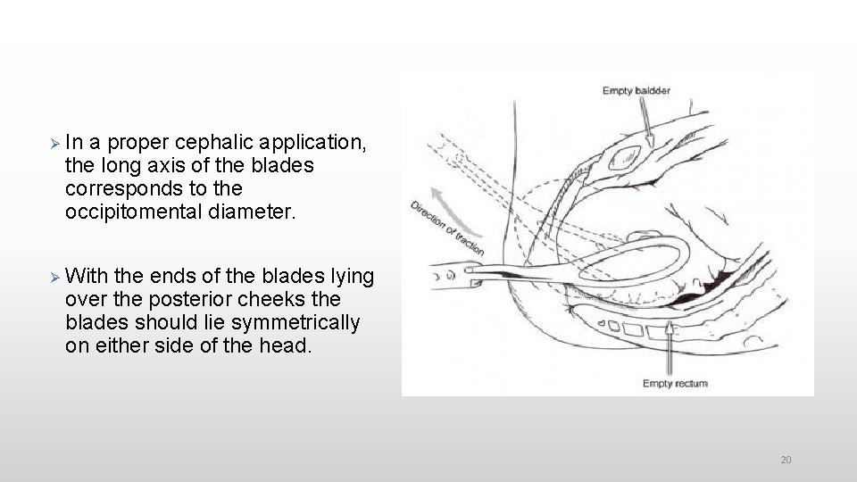  In a proper cephalic application, the long axis of the blades corresponds to