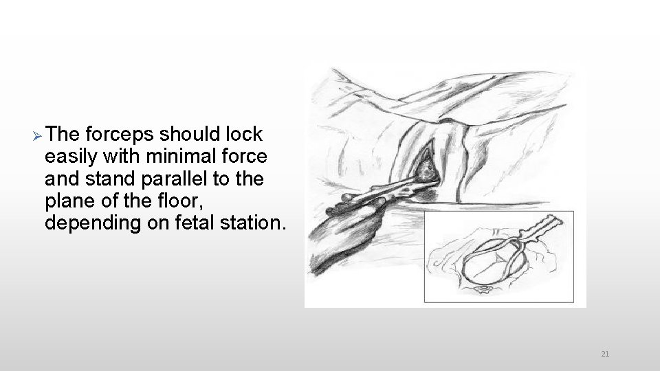  The forceps should lock easily with minimal force and stand parallel to the
